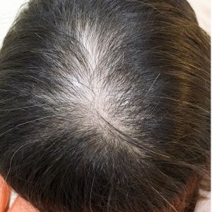 Revix Clinic | Mesotherapy for Hair Loss Revix Clinic|Mesotherapy for Hair Loss