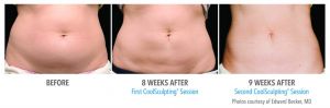 Revix Clinic|Coolsculpting