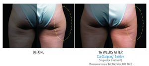 Revix Clinic|Coolsculpting