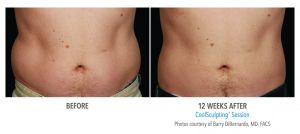 Revix Clinic|Coolsculpting