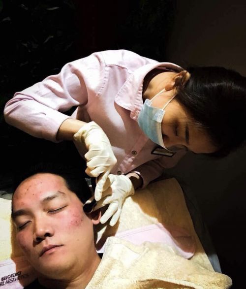 Revix Clinic | Dermaroller Microneedling