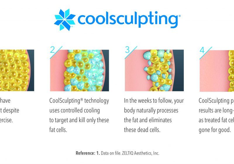 Revix Clinic | Coolsculpting how-coolsculpting-works-Medium-1024x563