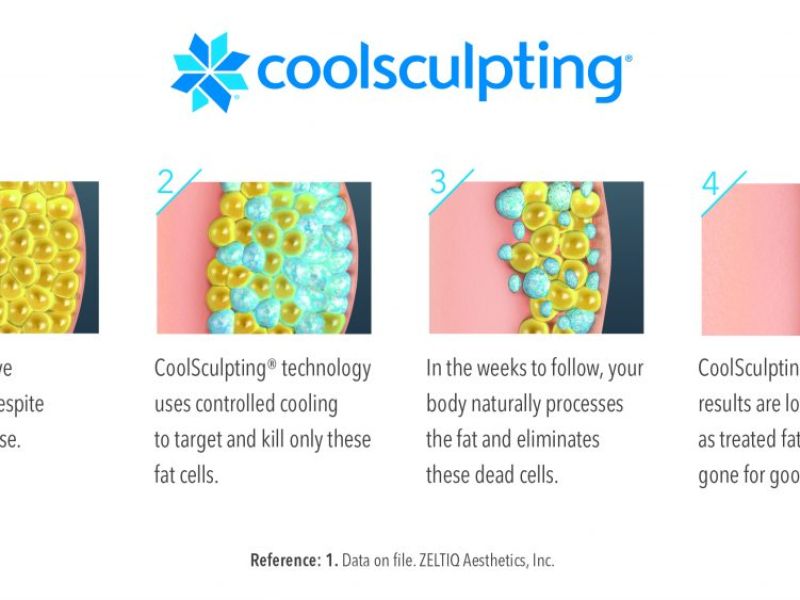 Revix Clinic | Coolsculpting how-coolsculpting-works-Medium-1024x563