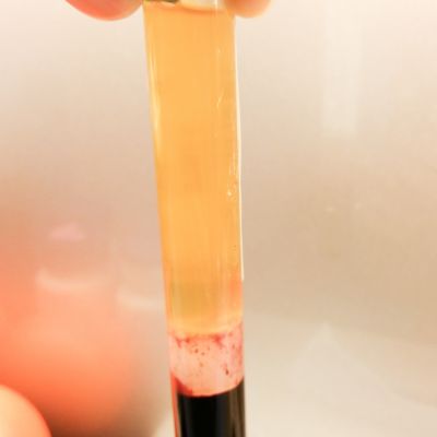 Revix Clinic | Platelet Rich Plasma (PRP) PRP