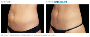 Revix Clinic | Emsculpt Revix Clinic|Emsculpt