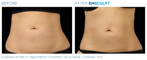 Revix Clinic | Emsculpt Revix Clinic|Emsculpt