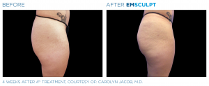 Revix Clinic | Emsculpt Revix Clinic|Emsculpt