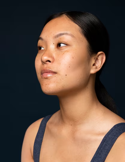 Revix Clinic | Unmasking Melasma: The Truth Behind Its Causes and Cures unnamed