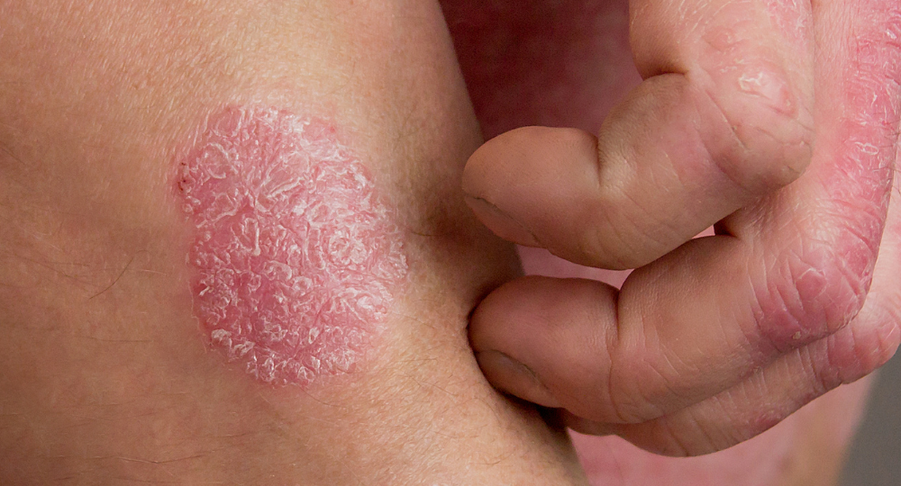 マレーシアにおける総合的な湿疹治療：腸の健康、皮膚の回復、炎症の抑制