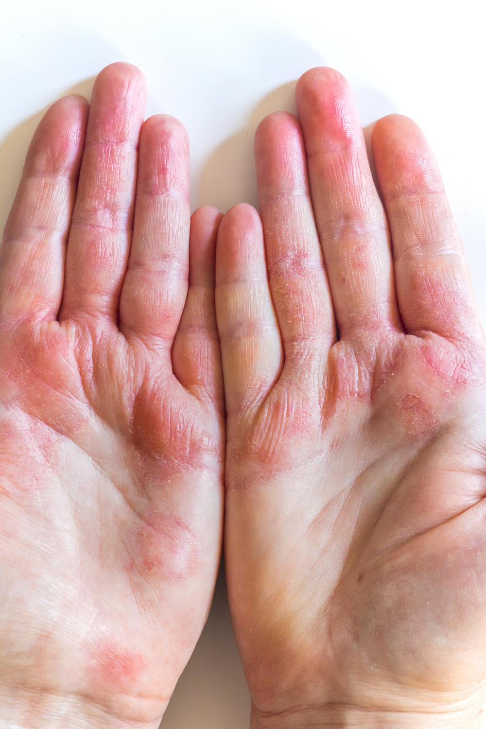 Revix Clinic | Eczema on the Rise: Comprehensive Guide to Understanding and Managing Atopic Dermatitis in Malaysia skin clinic kota kemuning