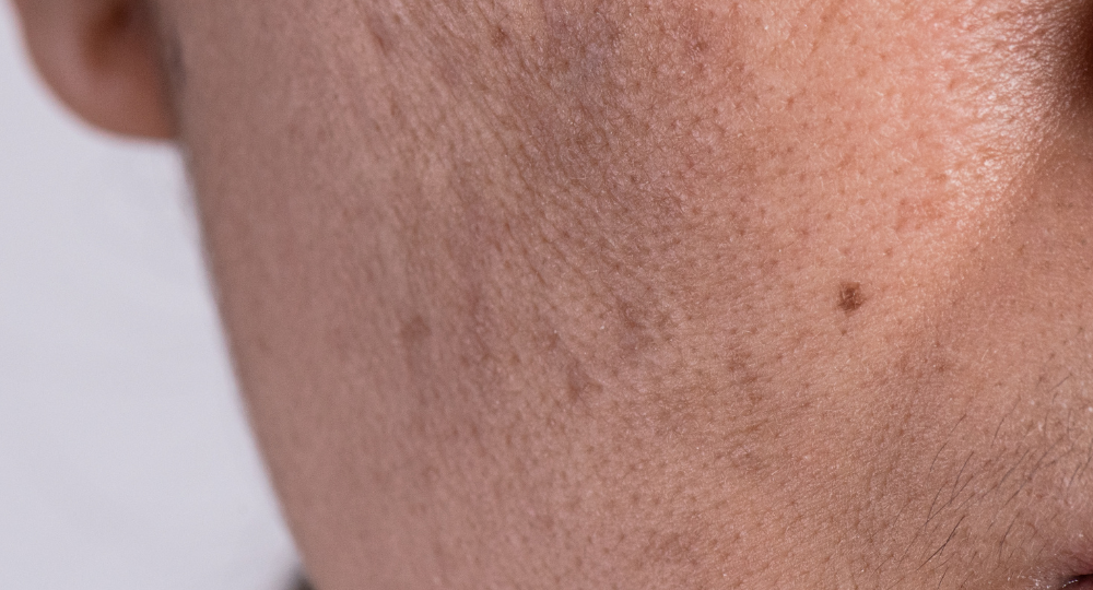 Melasma pigmentation on the face caused by hormonal imbalance