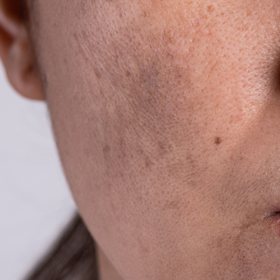 Melasma pigmentation on the face caused by hormonal imbalance