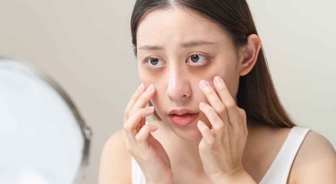 Revix Clinic | Why You Still Have Dark Eye Circles (Even If You’re Sleeping Well)