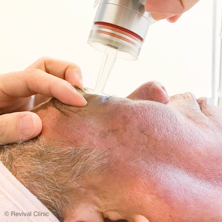 Revix Clinic | Why Acne Scars Don’t Just Fade (And What You Can Do About It)