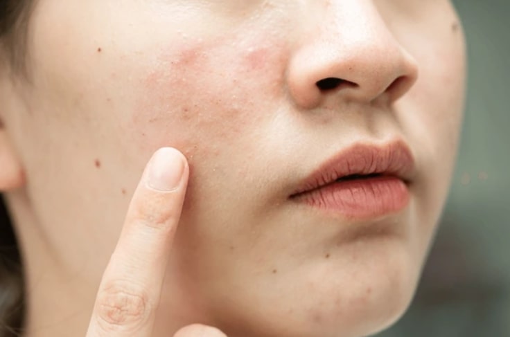 Revix Clinic | Why Acne Scars Don’t Just Fade (And What You Can Do About It)