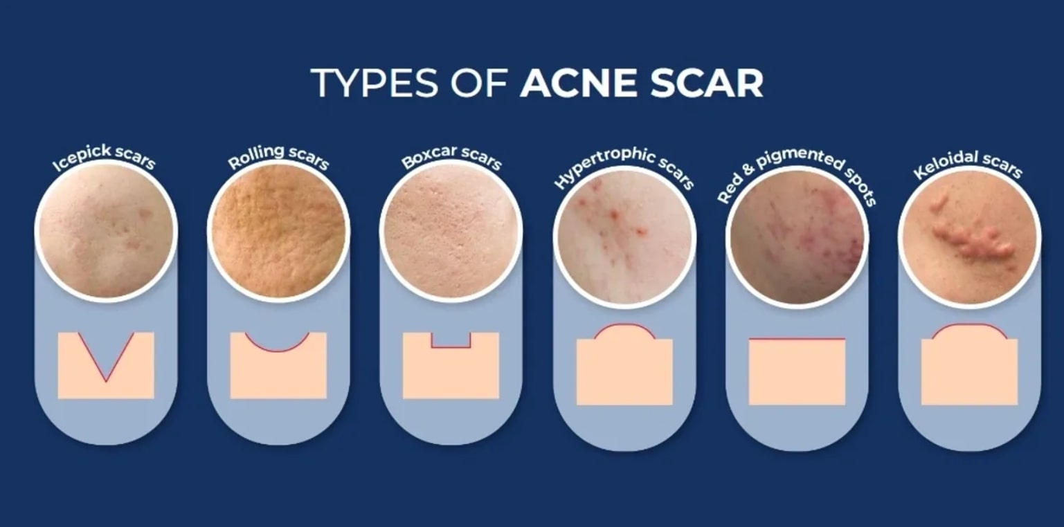 Revix Clinic | Why Acne Scars Don’t Just Fade (And What You Can Do About It)