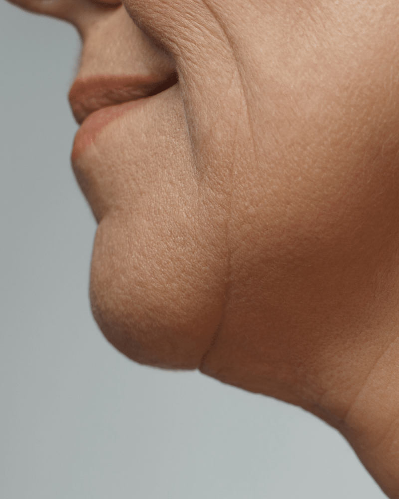 Revix Clinic | Facial Sagging Explained: A Comprehensive Guide to Understanding and Restoring Firmness Naturally aesthetic clinic kota kemuning