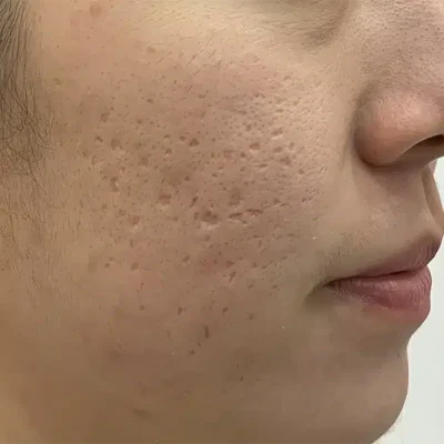 acne scar