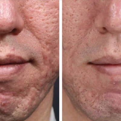 Microneedling_for_acne_scars