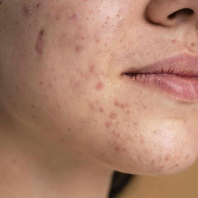 confident-young-woman-with-acne-close-up
